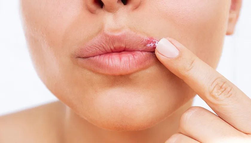 Mujer con herpes en el labio. en aposán, te explicamos las causas del herpes labial